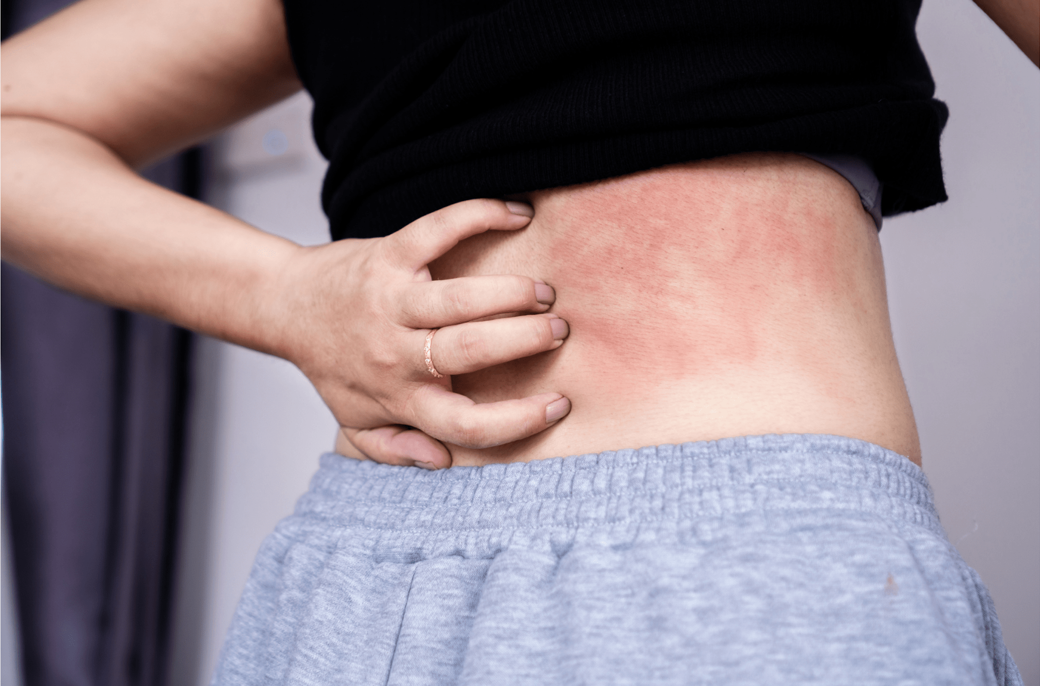 How I Cured My Chronic Hives After 15 Years Blissful and Well